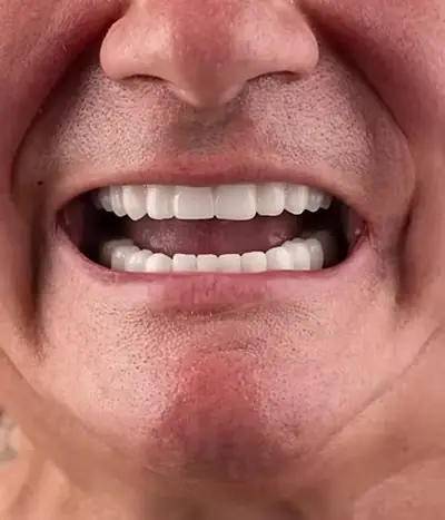 Tam ağız zirkonyum sonrası