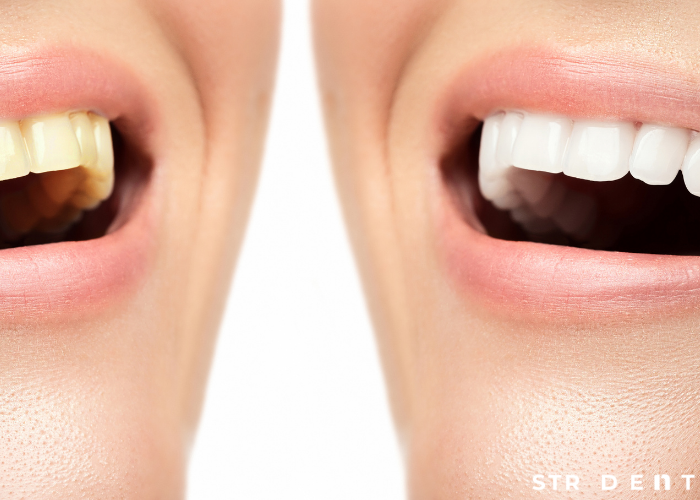 Zirkonyum Diş Kaplama Fiyatları Kayseri