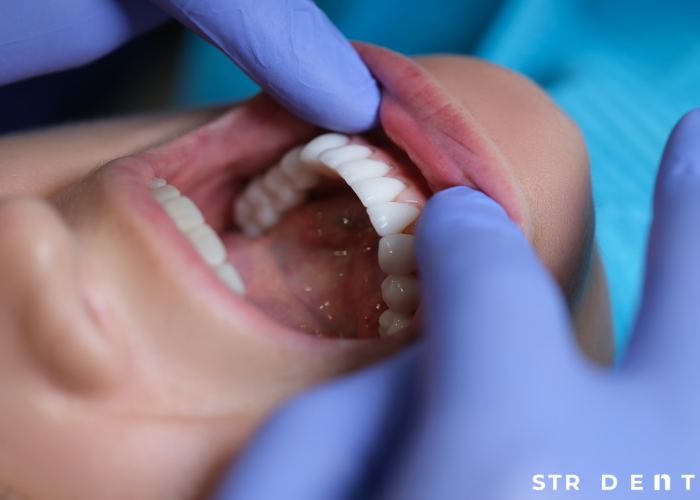<strong>Do Zirconium-Made Teeth Decay?</strong>