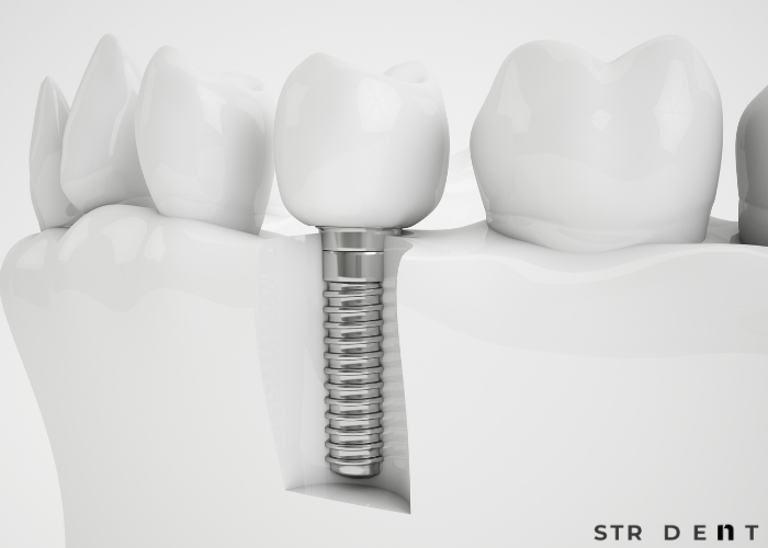 Diş İmplantı Yan Etkileri
