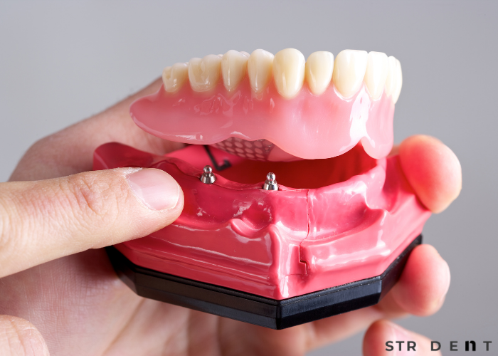 Kaplama Diş mi İmplant mı?