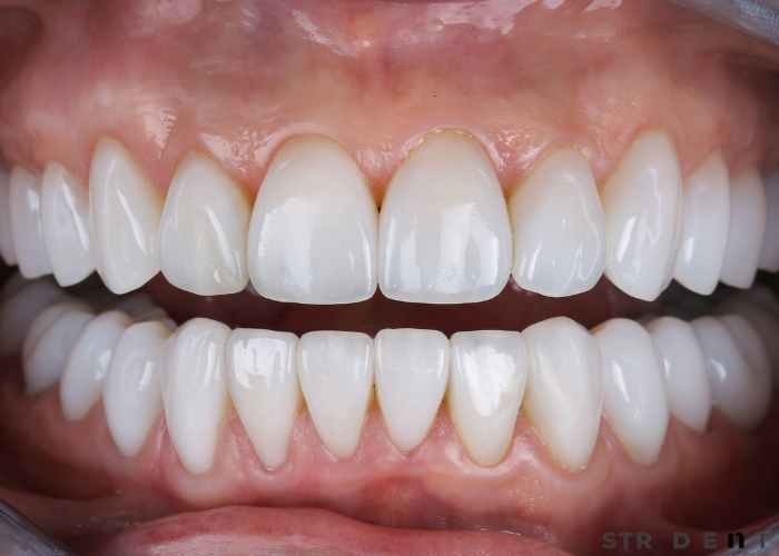 Titanyum Diş İmplantı