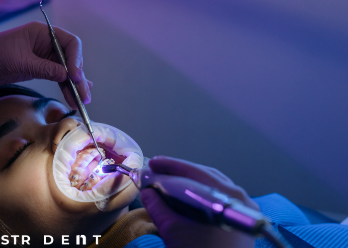 Diş Kaplama Yaptıranlar